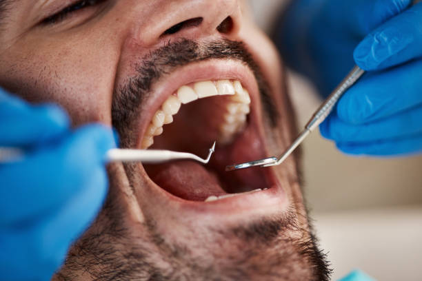 Best Emergency Dentist for Knocked-Out Tooth in Bellevue, IA