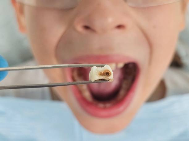 Best Emergency Dental Extractions in Bellevue, IA