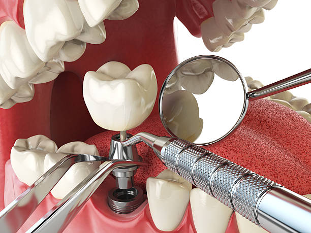 Best Emergency Dental Services for Seniors in Bellevue, IA